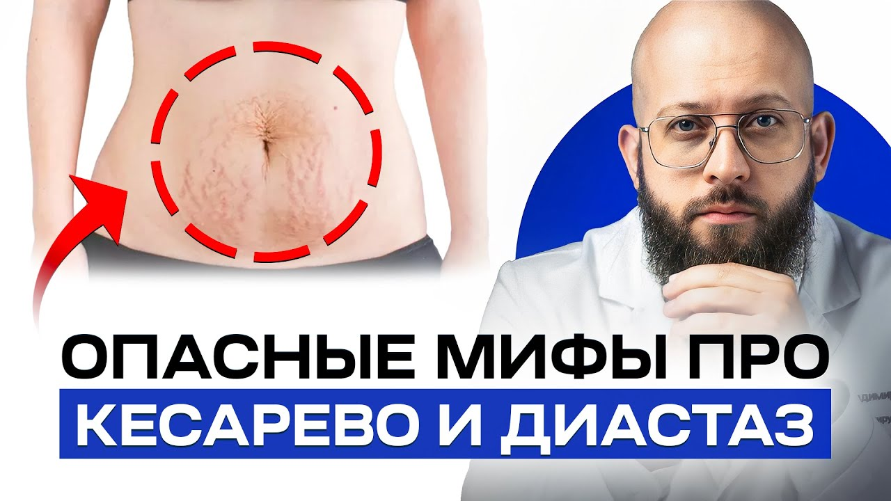 Бывает ли диастаз после кесарево сечения? Когда нужно лечить диастаз? смотреть онлайн