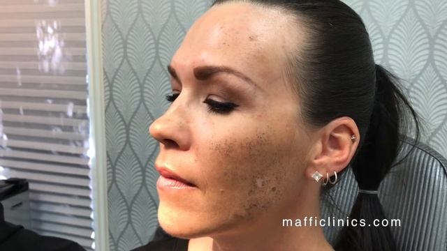 Maffi Clinics: Botox смотреть онлайн
