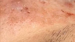 TOP 3 pimples Выдавливание акне [4]
