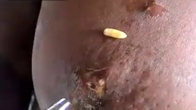 Опарыши в человеке