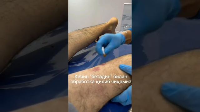 Варико ни Лазер билан даволаганда эртанги кундаги куруви. Лазер Варикозни даволашни энг яхшиси смотреть онлайн