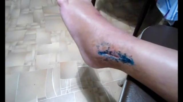 Гипс при переломе лодыжки сняли , внешний вид ноги, перевязка. Спорт и здоровье. Sport and health смотреть онлайн
