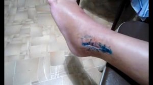 Гипс при переломе  лодыжки сняли , внешний вид ноги, перевязка. Спорт и здоровье. Sport and health
