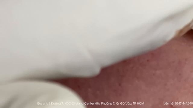 Big Cystic Acne Blackheads Extraction Blackheads & Milia, Whiteheads Removal Pimple Popping смотреть онлайн