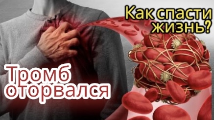 Тромб оторвался. Инфаркт лечение стентирование. ТЭЛА - тромбы в венах ног. Причины тромбов смотреть онлайн