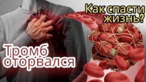 Тромб оторвался. Инфаркт лечение стентирование. ТЭЛА - тромбы в венах ног. Причины тромбов