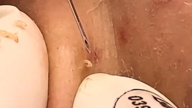 Страшно красивые прыщи на лице 𝐏𝐫𝐨𝐟𝐞𝐬𝐬𝐢𝐨𝐧𝐚𝐥 𝐑𝐨𝐲𝐚𝐥 𝐅𝐚𝐜𝐢𝐚𝐥 𝐂𝐚𝐫𝐞 𝐰𝐢𝐭𝐡 𝐓𝐇#9 إزالة البثور السوداء смотреть онлайн