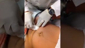 шов после кесарева сечения