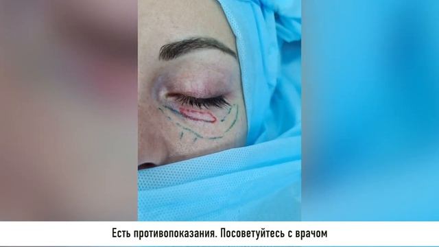 Липофилинг нижних век.Подробная диагностика и описание. смотреть онлайн