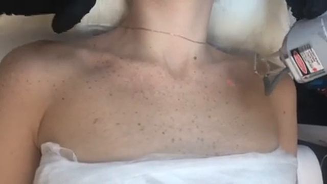 Лазерный пилинг смотреть онлайн