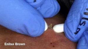 Blackhead Extractions On The Forehead/ Christian Part 1