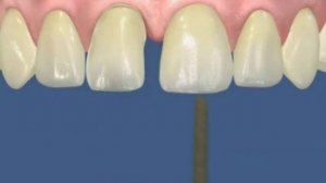 Художественная реставрация зубов