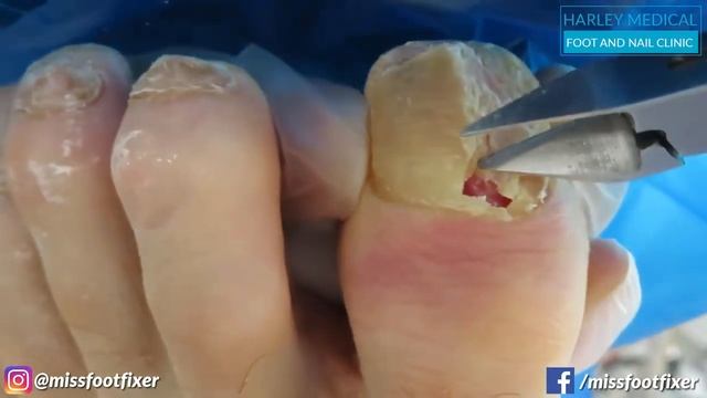 Инфекция ног. Удаление ногтя. Как лечить инфекцию ног с помощью крема смотреть онлайн