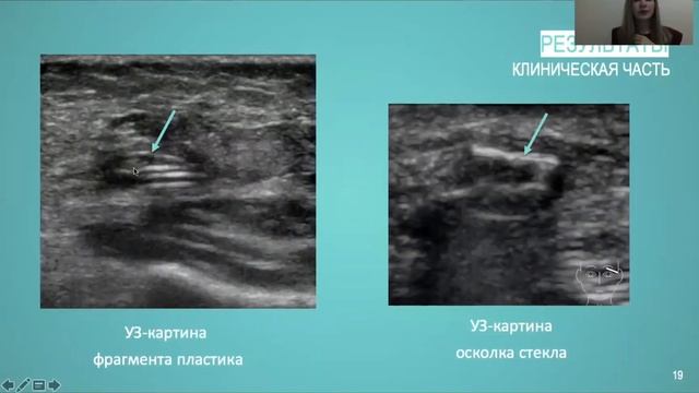 Возможности УЗ диагностики в визуализации инородных тел мягких тканей челюстно-лицевой области
