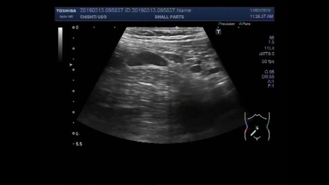 Ultrasound Video showing multiple enlarged lymph nodes, i.e. Lymphadenopathy. смотреть онлайн