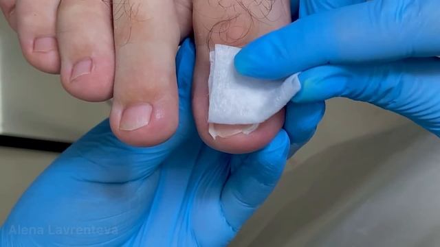 Вросший ноготь / Выстригал вросший ноготь сам / Тампонада вросшего ногтя / Врос на ноге что делать