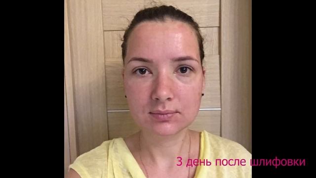 Лазерная шлифовка постакне смотреть онлайн