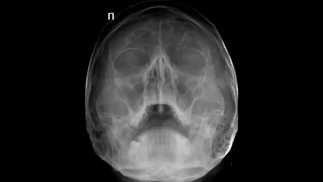 Укладка пациента для снимка пазух