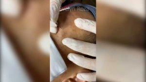 How to removal blackheads on face so relax | Best Pimple Popping (#2)