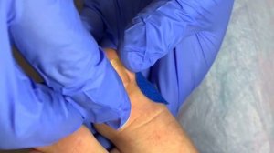 Вросший ноготь ⚠️?⚠️?? • Удаление вросшего ногтя ???