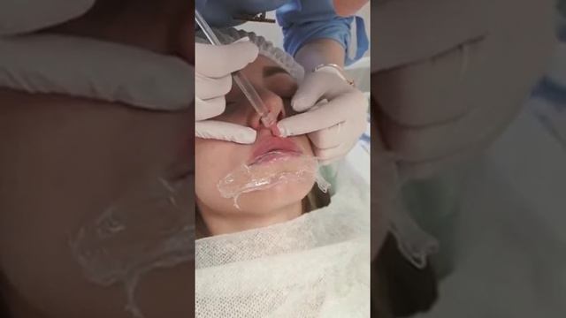 Контурная пластика губ , как создаются идеальные губы 👄💉 смотреть онлайн