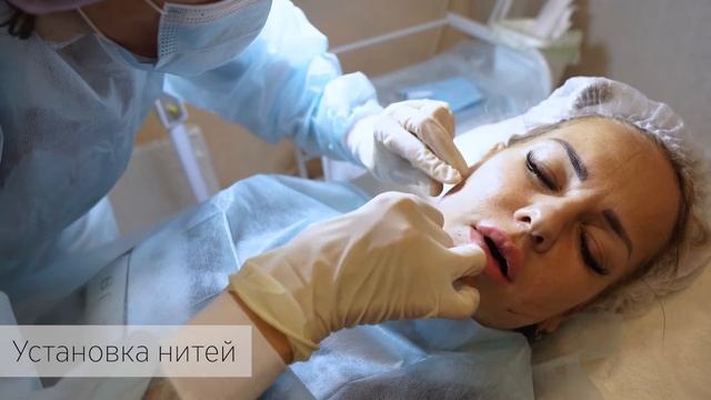 Нитевой лифтинг с использованием нитей модификации Cog