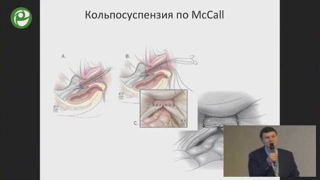 Опущение и выпадение тазовых органов у женщин (Шкарупа Д.Д.) смотреть онлайн