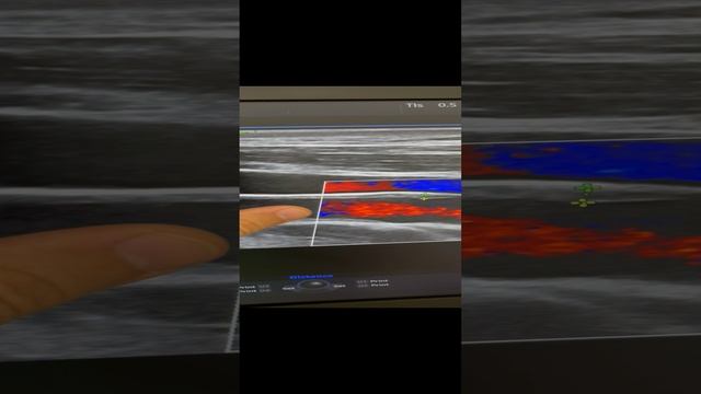 Ещё одна врачебная ошибка. Узи сосудов. Сосудистый хирург. Флеболог Москва смотреть онлайн