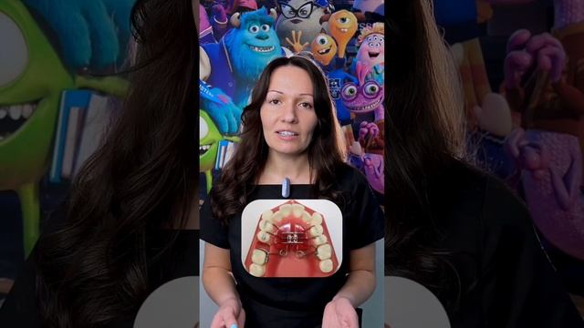 Можно ли детям ставить брекеты