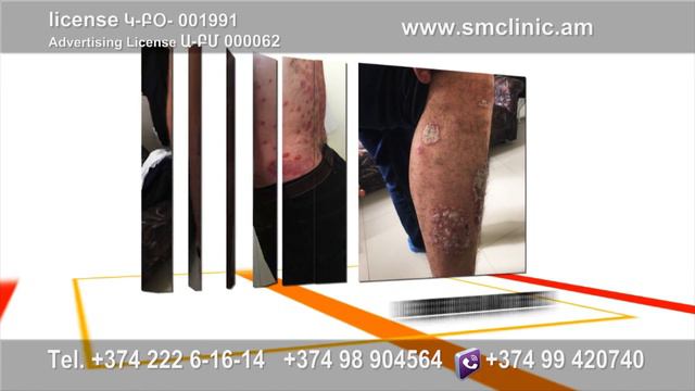 Psoriasis treatment - Treatment of skin diseases смотреть онлайн