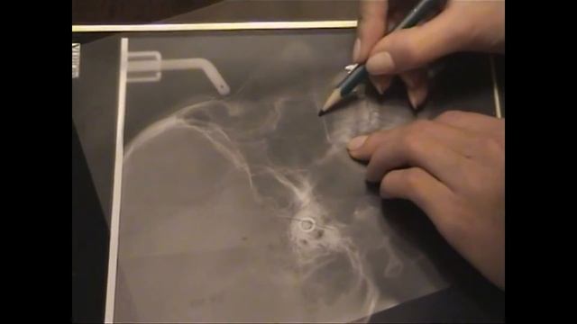 трг обрисовка. Cephalometric tracing смотреть онлайн