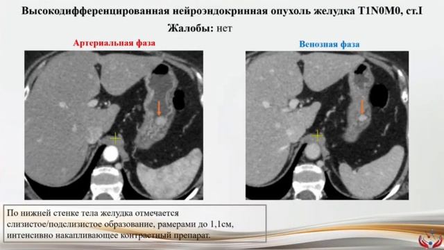 Особенности лучевой диагностики нейроэндокринных опухолей желудочно-кишечного тракта смотреть онлайн