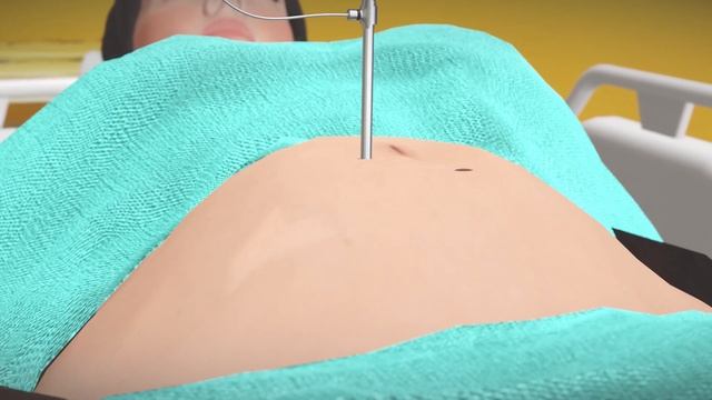 Female Sterilization: Everything You Need to Know (3D Animation) смотреть онлайн