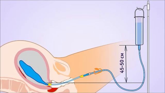 Идеология маточной баллонной тампонады Жуковского при послеродовом кровотечении смотреть онлайн