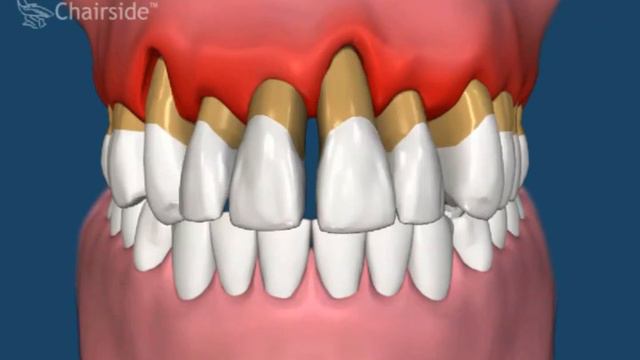 Воспаление десны вокруг зуба вид со стороны десны смотреть онлайн