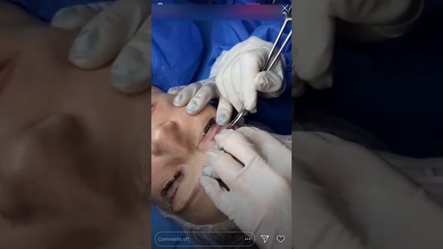 ? БЛЕФАРОПЛАСТИКА от курьера БРАУДЭ ! СЕМИНАР! смотреть онлайн