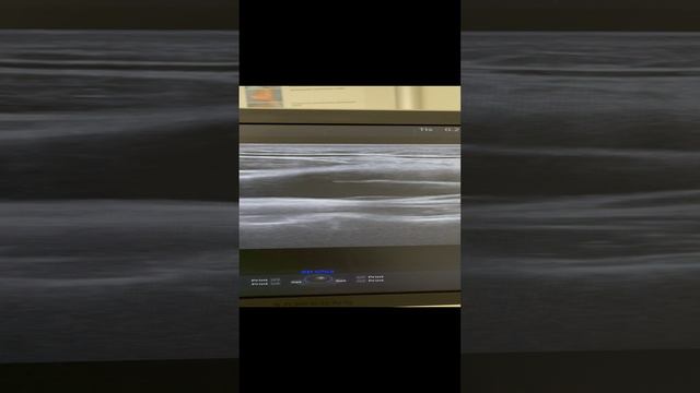 Атеросклероз у парня. Узи сосудов. Сосудистый хирург. Флеболог Москва смотреть онлайн