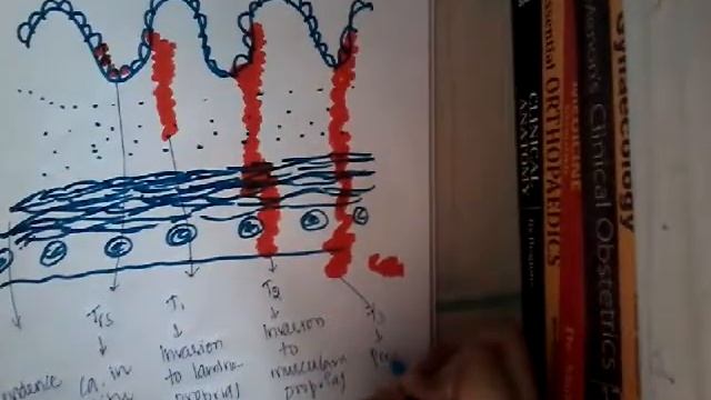 gastric cancer Tnm staging || stomach || git смотреть онлайн