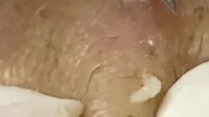 чистка лица от черных точек #29