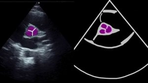 Базовые навыки ЭхоКГ