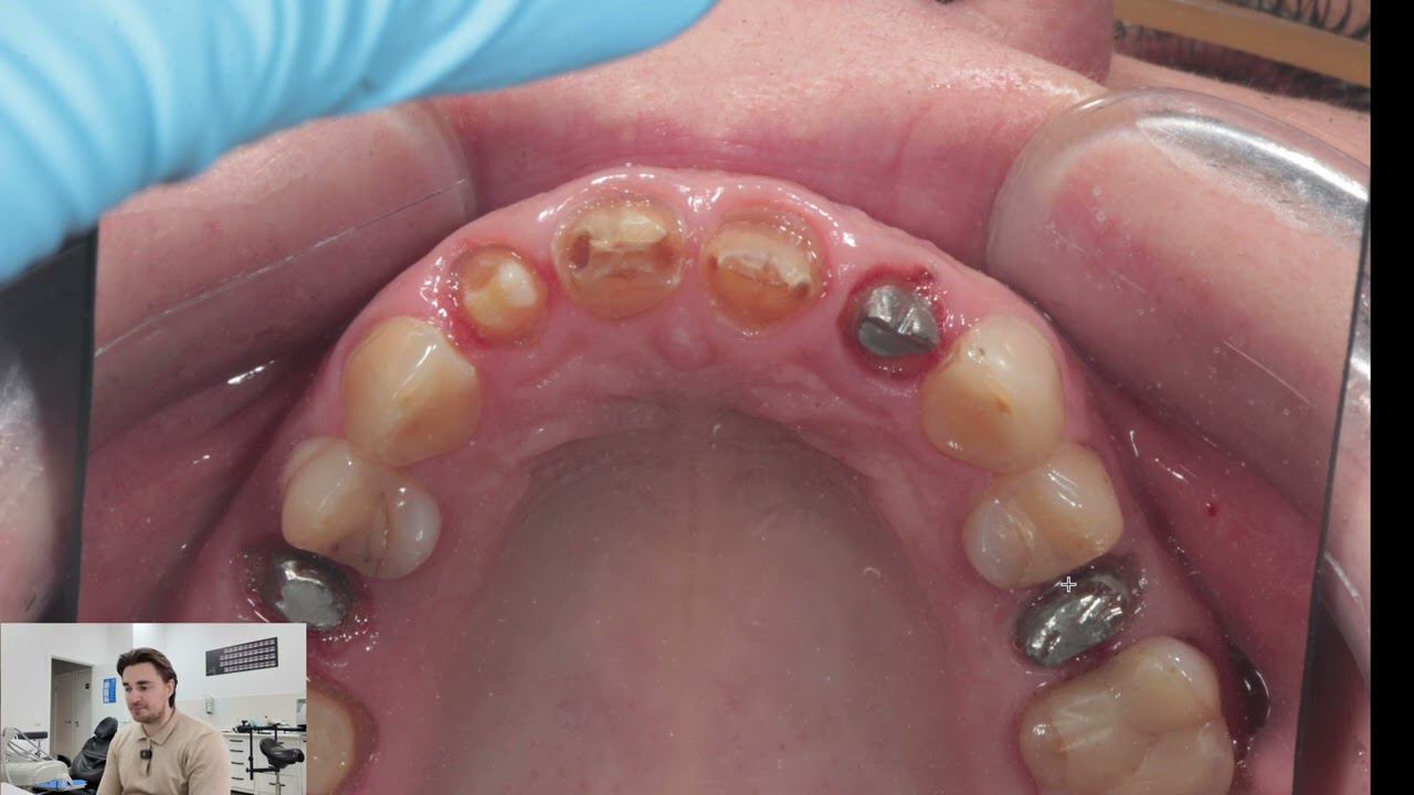 СТОМБУДНИ#34 Восстановление зубов. Билдап, Вкладка или штифт? смотреть онлайн