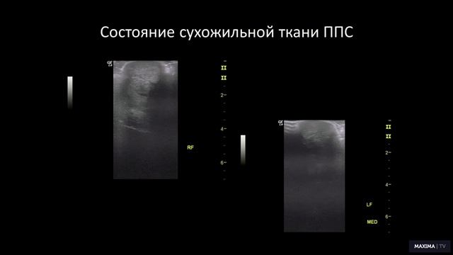 Мария ЖУКОВА: Лечение сухожильно-связочных структур с использованием секретома стволовых клеток смотреть онлайн