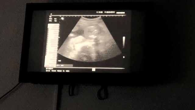 Узи 20 недель (второй скрининг, девочка)