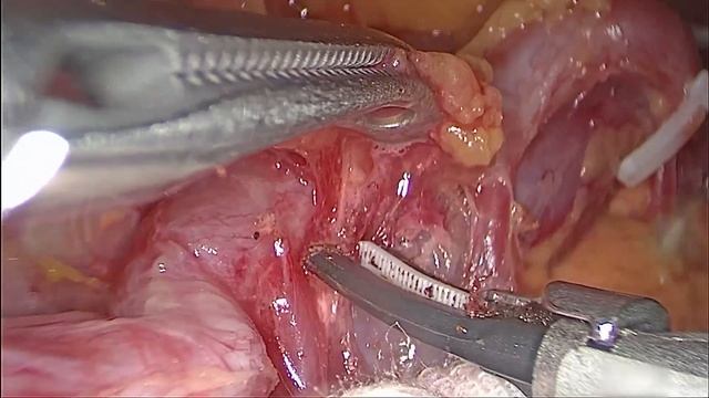 Laparoscopic Spleen-Preserving No. 10 Lymph Node (LN) Dissection смотреть онлайн
