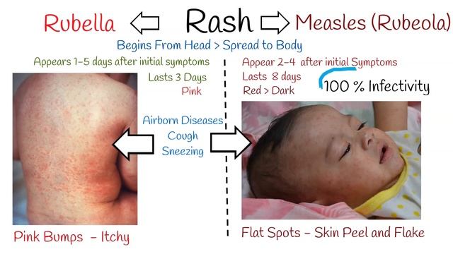 Rubella vs Rubeola (Measles vs German Measles) смотреть онлайн
