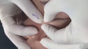 Professional bleckheads   Выдавливание черных точек прыщей   самое залипательное видео 2022