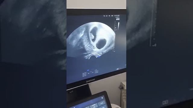 Первое УЗИ// Сердцебиение ❤️♥️ смотреть онлайн