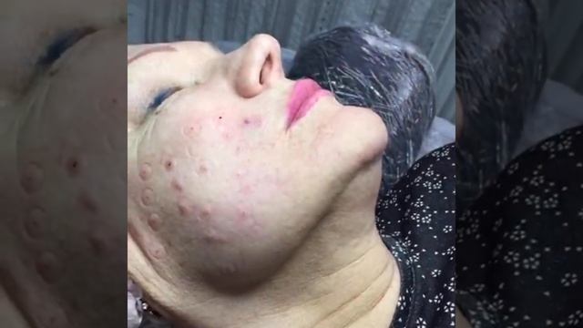 Гиалуроновый пистолет. Гиалурон Пен обучение смотреть онлайн