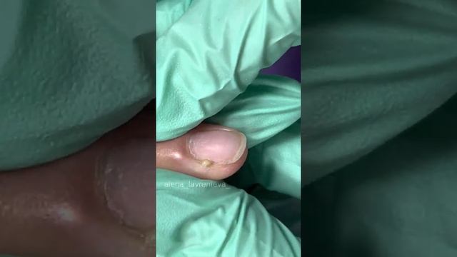оторвала заусенец / Гной на пальце / загноился палец? / Опух палец, что делать? #Shorts смотреть онлайн