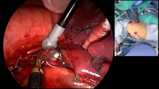 Asvide: Mediastinal lymph node dissection of 4L смотреть онлайн